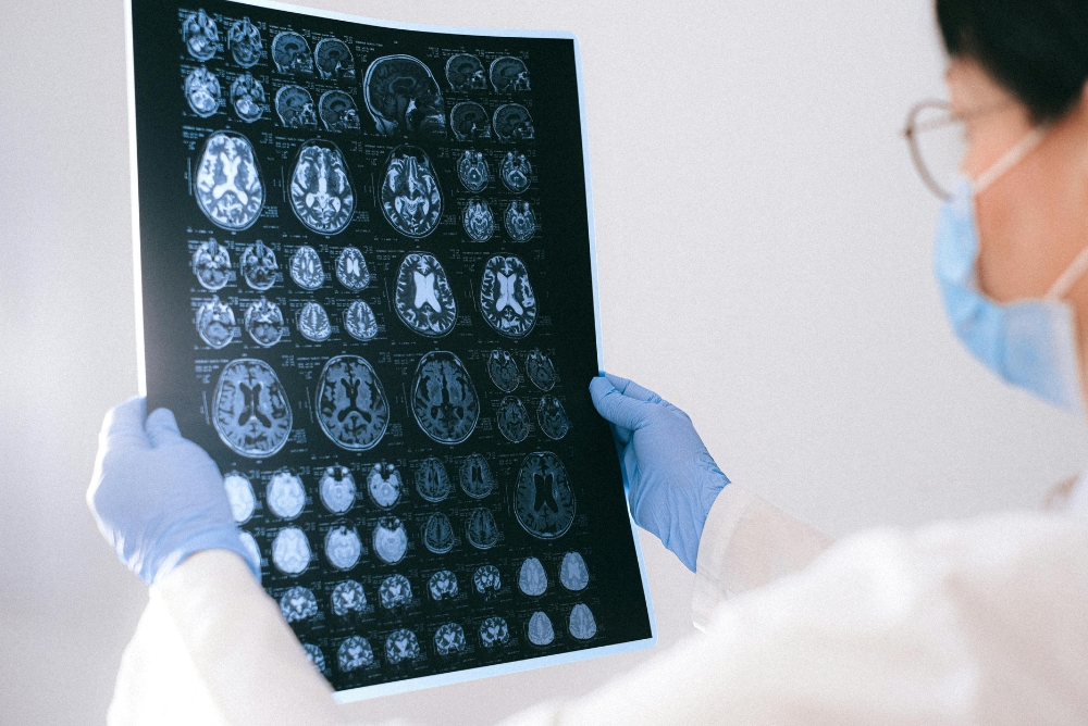 Benefits and Success of AVM Embolization